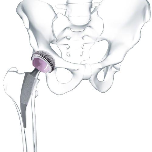 product.alt Metha® Short Hip Stem