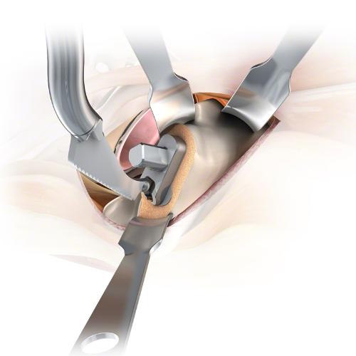 product.alt MIOS® Minimally Invasive Orthopaedic Solutions