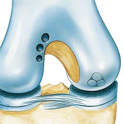 product.alt proCART Osteochondral Transplantation