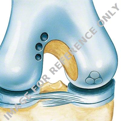 proCART Osteochondral Transplantation-<p>Arthroscopic treatment for cartilage defects</p>